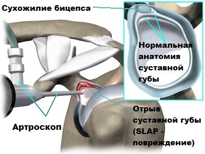 Повреждения SLAP суставной губы плечевого сустава. Этиология, симптомы ...
