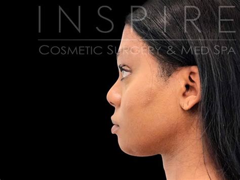 Facial Feminization 6 - Inspire Aesthetics