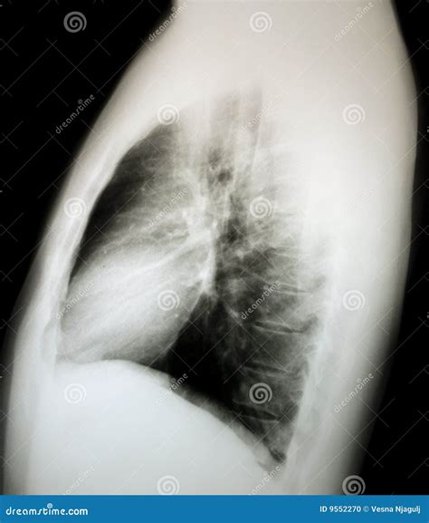 Normal X-ray Of The Chest, Lateral Stock Photo - Image: 9552270