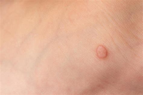 Common wart Verruca vulgaris on the skin of a child. 11771242 Stock