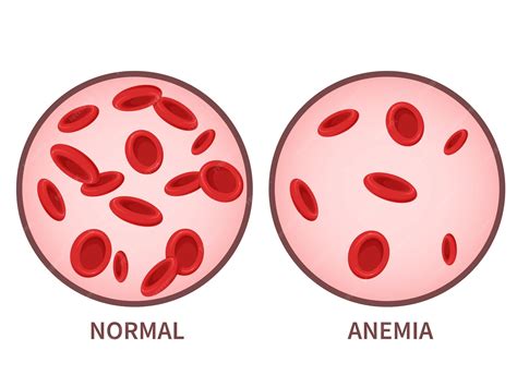 hemoglobin anemia symptoms blood disease health care concept