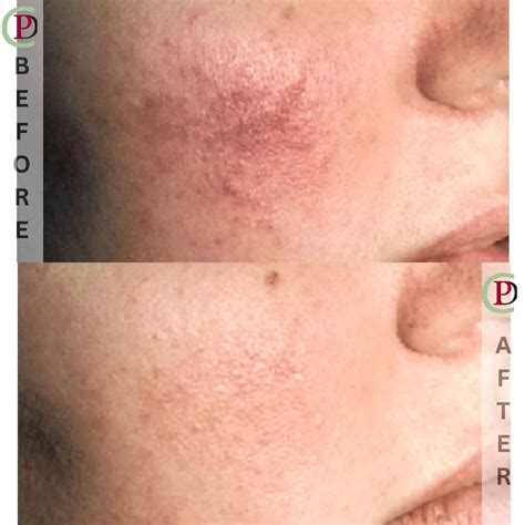 Vbeam Laser | Before & After Results | Premier Derm Center