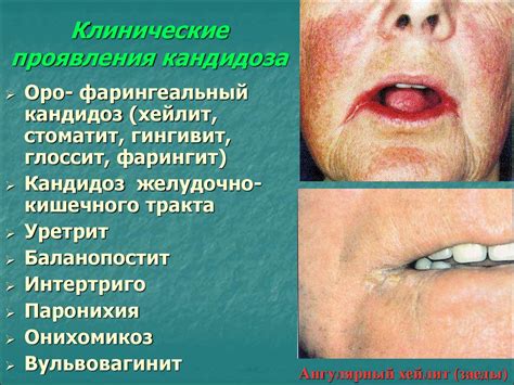 Грибковые заболевания кожи. Общая микология. Малосезиозы. Трихомикозы ...