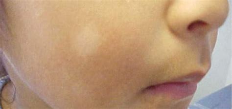 Pityriasis Alba - White spots on face of child - Key To Perfect Health