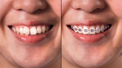 Dentes Depois Do Aparelho