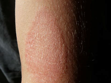 Dyshidrotic Eczema: Dyshidrotic Eczema Symptoms, Causes and More