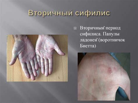 Сифилис. Симптомы сифилиса - презентация онлайн