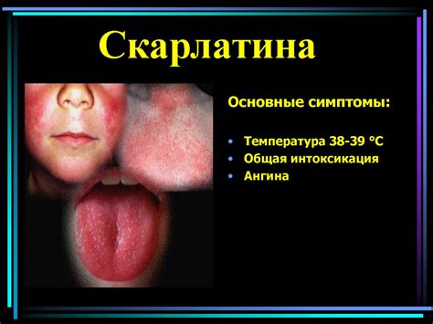 Дифференциальная диагностика инфекционных экзантем - презентация онлайн