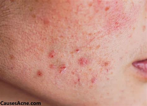 what does hormonal acne look like - Causes Acne