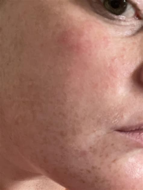 face red blotches 4