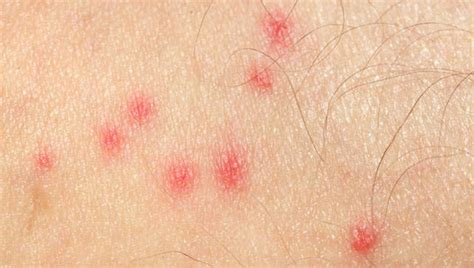 Mosquito Bites Allergies Symptoms and Treatment