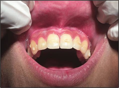 Labial Frenulum Normal