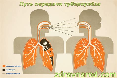 Как вылечить туберкулёз | Реальные истории лечения