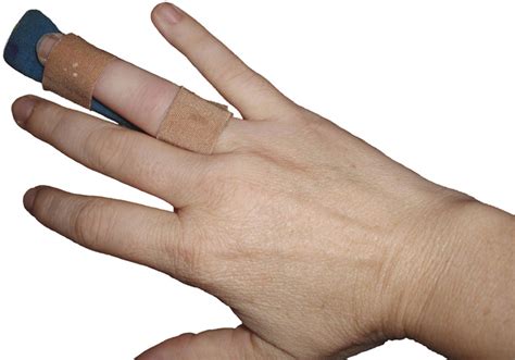 broken finger susslandcom