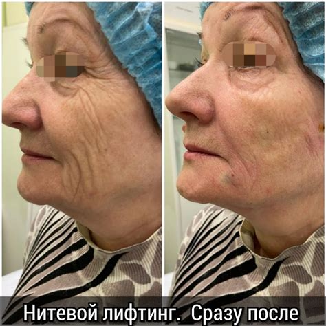 Цены на подтяжку лица нитями Иркутск - Аши, косметологическая клиника