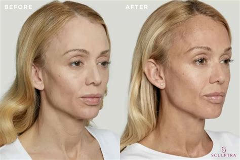 Sunken Cheeks - Freyja Medical