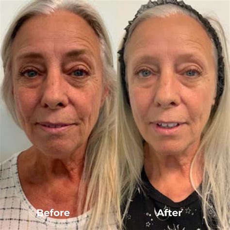 Radiofrequency Microneedling Before and After Photos - House of Beauty
