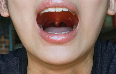 uvulitis     occur illnesses step  health