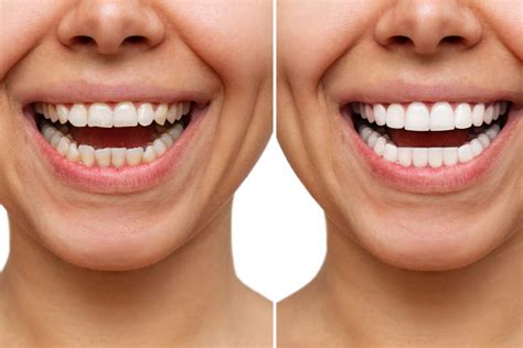 Зъбни фасети: цена, видове и особености|Medical Dent