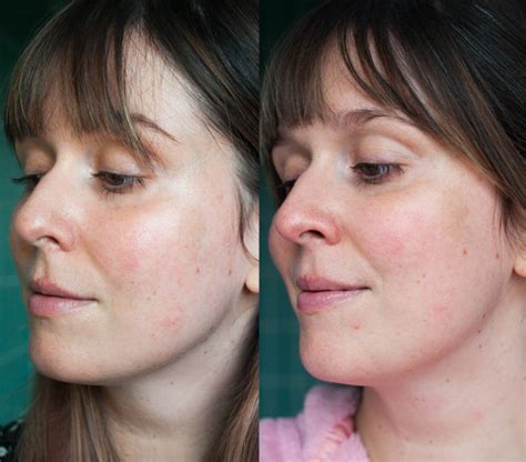 Beauty: does dermarolling work? - THE STYLING DUTCHMAN.