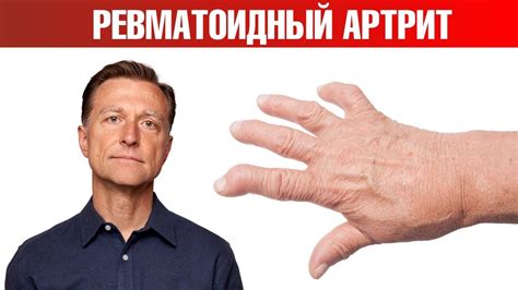 Нужен ли Метотрексат при ревматоидном артрите