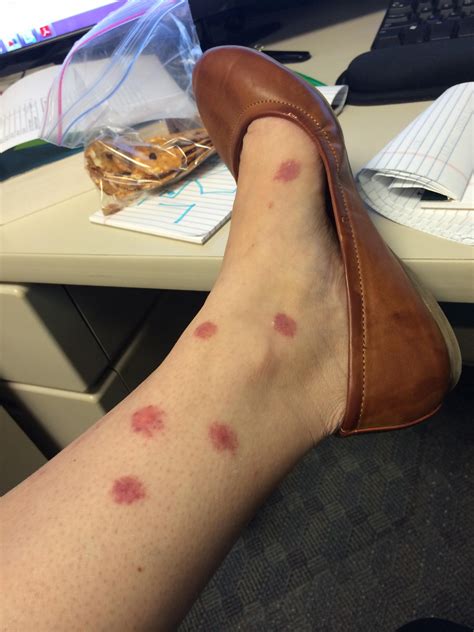 Mosquito Bite Allergic Reaction Treatment at Eddie Avila blog