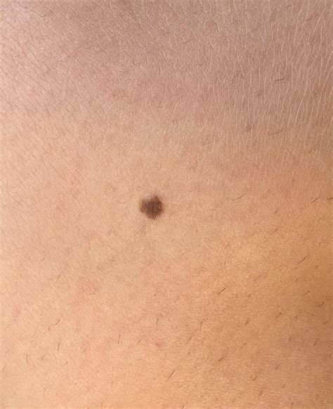 Evolving mole? : r/DiagnoseMe