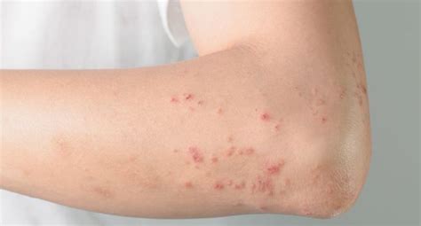 [DIAGRAM] Diagram Of Rash - MYDIAGRAM.ONLINE