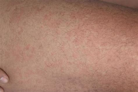 Bactrim Rash