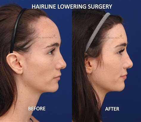 Hairline restoration surgery for a big forehead will grow in 2026 26