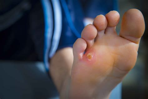 how to treat corns on feet 13
