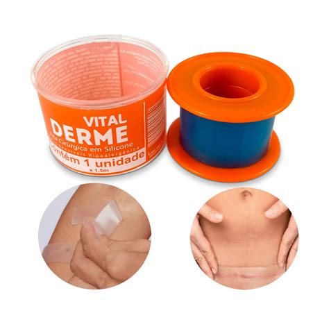 Qual A Melhor Fita De Silicone Para Cicatriz - Fita cirúrgica de silicone para cicatriz e queloide 05cm x 1,5m pele ...