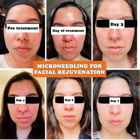 How Long After Microneedling Can I Workout - EMSEKFLOL.COM