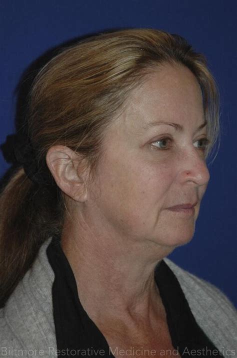 dermal fillers ba patient  biltmore