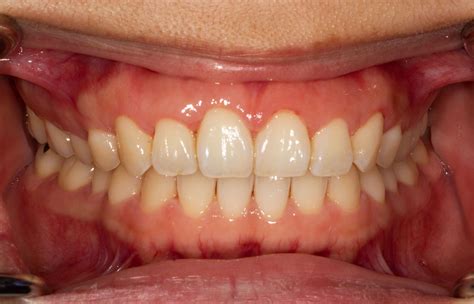 gum  color change  edna mondragon blog