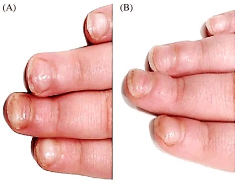 Psoriasis of the fingernails showing pitting, oil drop, yellowish ...