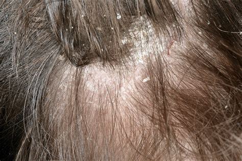 Seborrheic dermatitis, what is it?