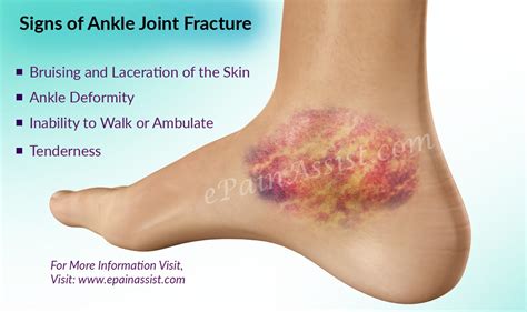 Symptoms Of Blood Clot Broken Ankle at Everett Reynolds blog