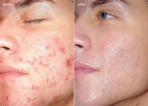 Microdermabrasion Before and After (Results + Pictures) - the daily glimmer