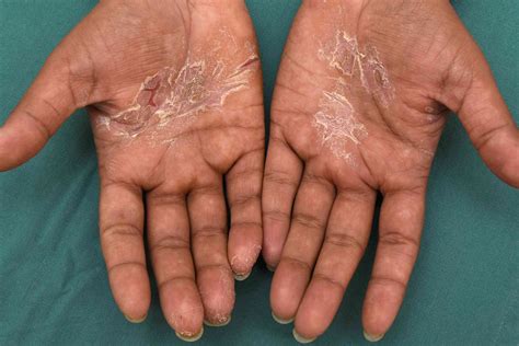 Hand Rash: 12 Possible Causes and Treatment Options