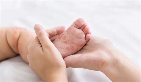 ROUGEOLE : Une explication de ses complications neurologiques | santé log