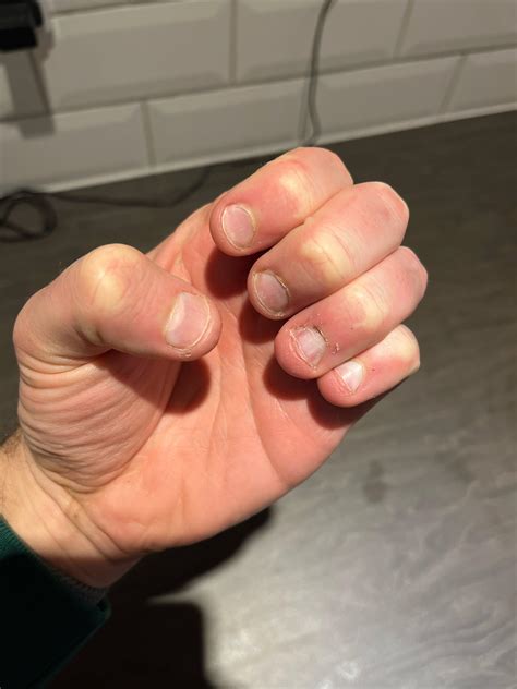 Found this community and making a start to stop biting my nails! Day 0