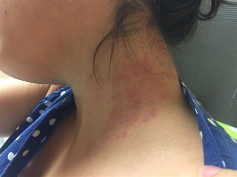 Dust Mite Bites: Pictures, Symptoms, Treatment, Prevention | atelier ...