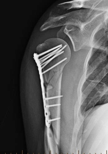 Proximal Humerus Fracture (Broken Humerus) | Reno Orthopedic Center