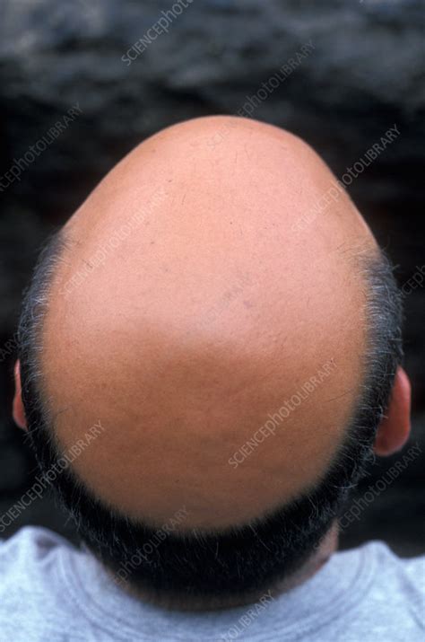 baldness stock image  science photo library