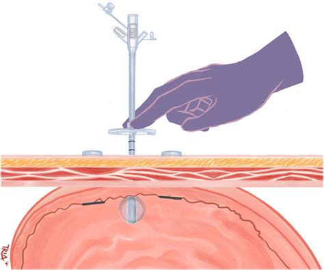 deconstructing  steps  peg tube insertion   introducer