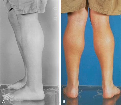 Muscle Diseases - Clinical Tree