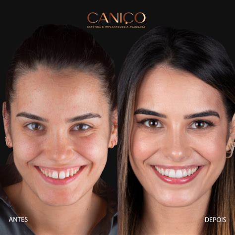Dente Separado Na Frente - Diastema (dentes separados) como resolver? - Clínica Caniço
