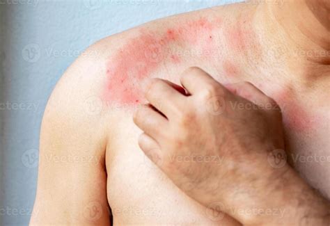 cerca arriba mano de  hombre rascarse   produce picor piel en