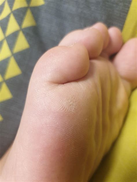 Had a verruca for a year or so, tried freezing it a few times with no